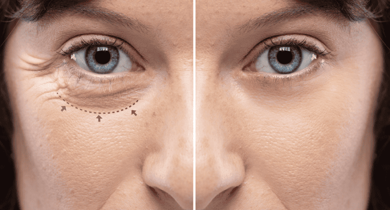 Upper and Lower eyelid blepharoplasty. Beautiful middle age woman getting ready for eyelid lift plastic surgery before and after Treatment | Adam J Cohen, MD in Glenview & Chicago, IL