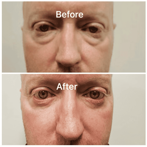 Old male Faces with Upper and Lower eyelid blepharoplasty treatment before and after | Adam J Cohen, MD in Glenview & Chicago, IL