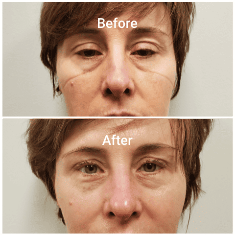 Young Female skin treatment before and after | Adam J Cohen, MD in Glenview & Chicago, IL