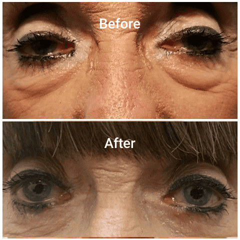 Old Female Faces with Upper and Lower eyelid blepharoplasty treatment before and after | Adam J Cohen, MD in Glenview & Chicago, IL