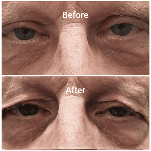 Old male Faces with Upper and Lower eyelid blepharoplasty treatment before and after | Adam J Cohen, MD in Glenview & Chicago, IL