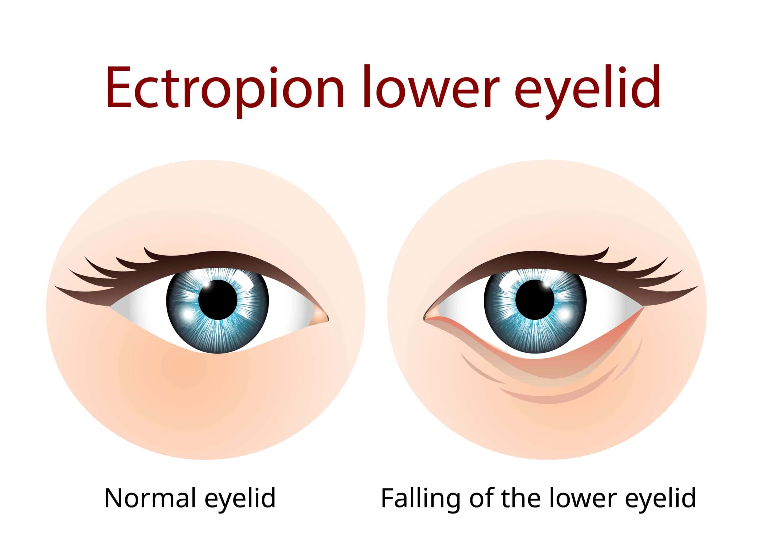 Ectropion Lower eyelid, Ectropion is a condition in which your eyelid turns outward. more common in older | Adam J Cohen, MD in Glenview & Chicago, IL