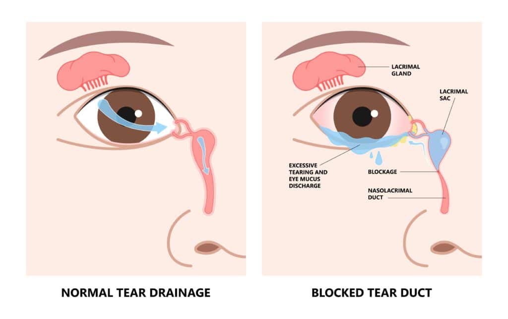 excessive-tearing-adam-j-cohen-md-in-glenview-chicago-il