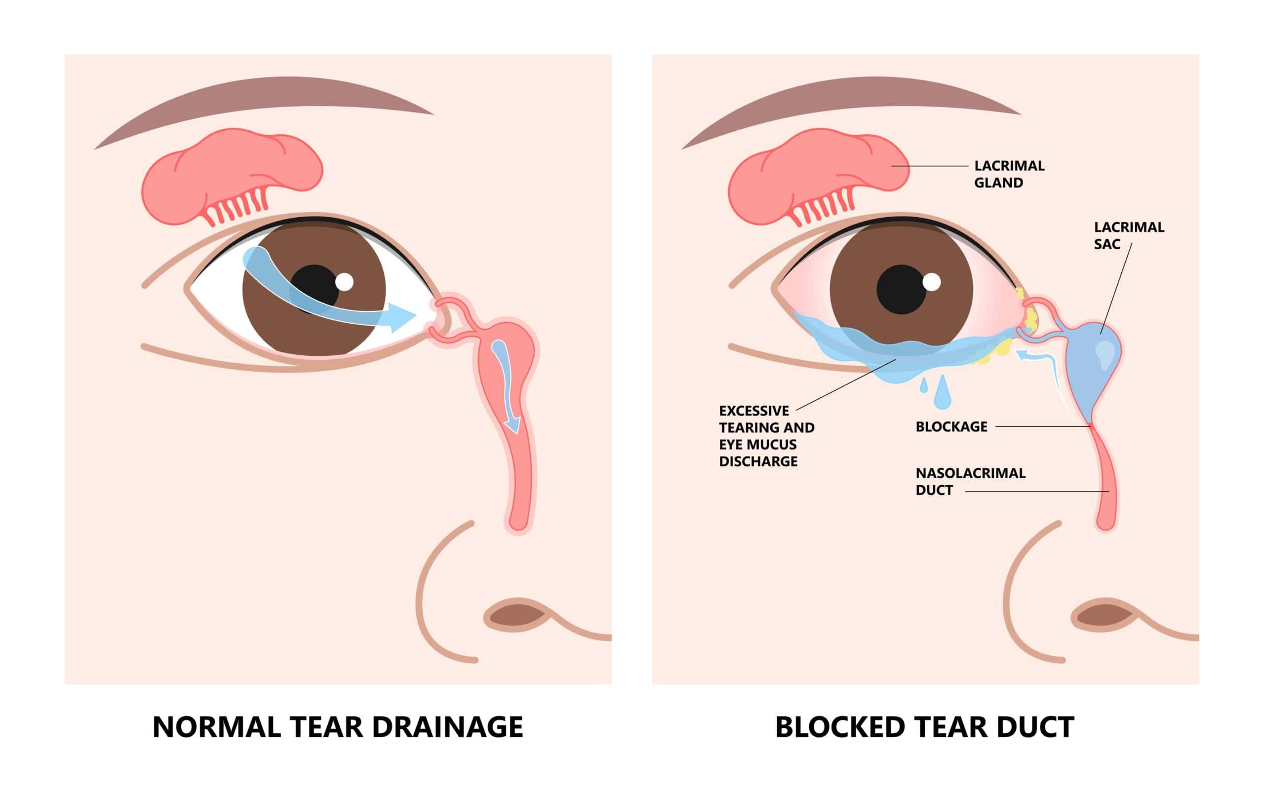 Blocked tear duct eye sinus toddler red dry swollen nasal nose pain eyelid Gland medial system drain sac birth baby child obstruct tumor polyps pink Mucus Eyedrop glaucoma Dacryolith disease | Adam J Cohen, MD in Glenview & Chicago, IL