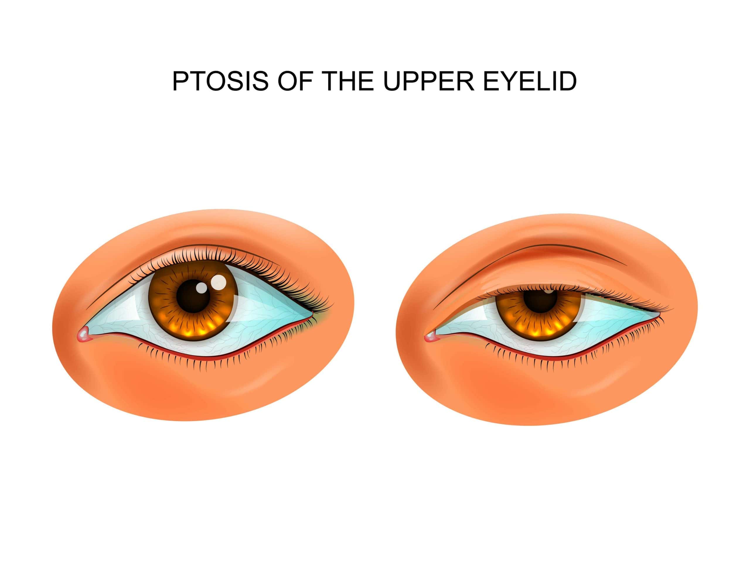 Vector illustration of ptosis of eyelid. paralytic drooping of the eyelid | Adam J Cohen, MD in Glenview & Chicago, IL