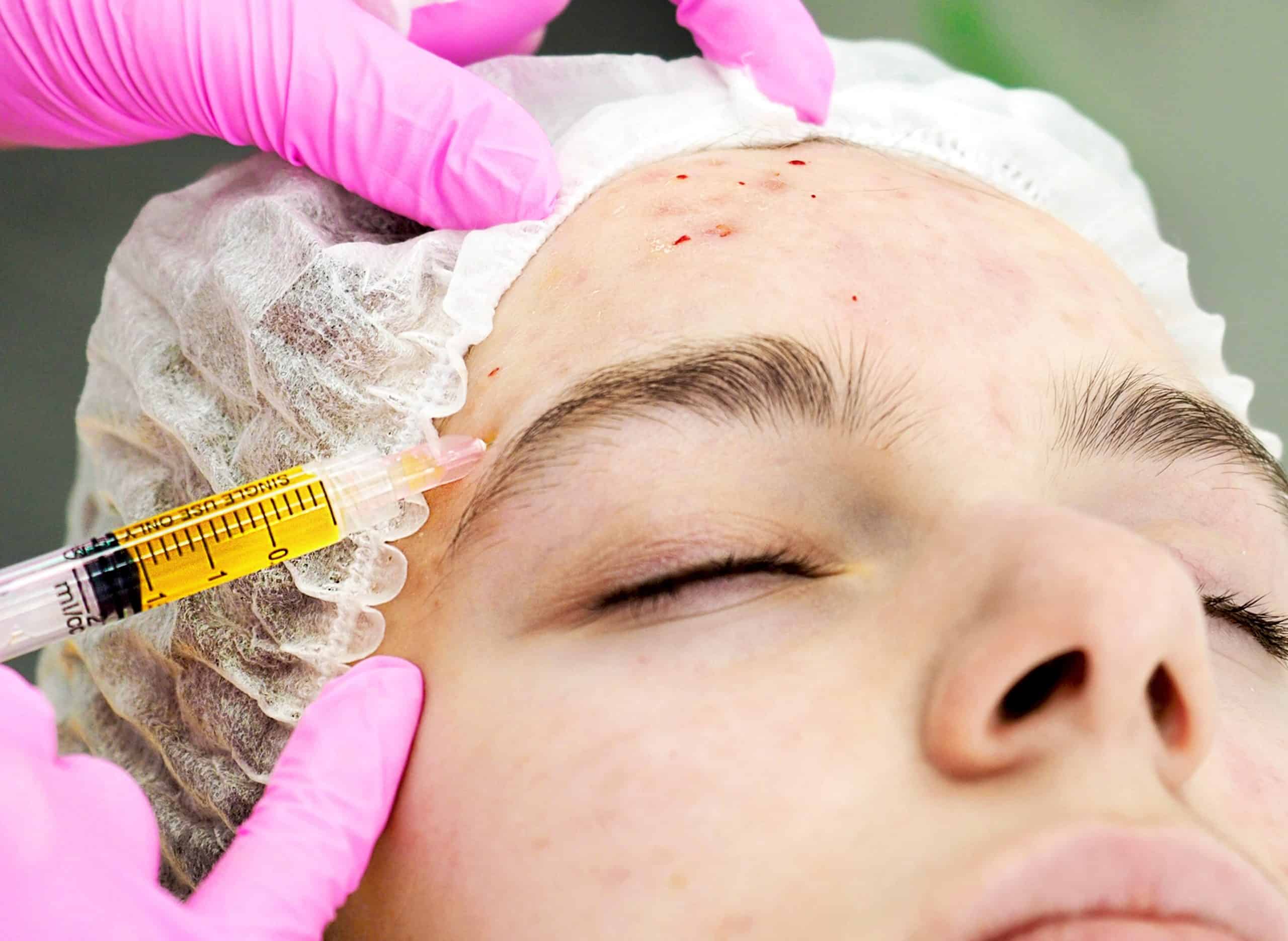 Young beautiful woman during facial PRP therapy. Beautician doing blood plasma injection for patient face skin cell restoration, close-up. The PRP Facelift: FAQs | Adam J Cohen, MD in Glenview & Chicago, IL